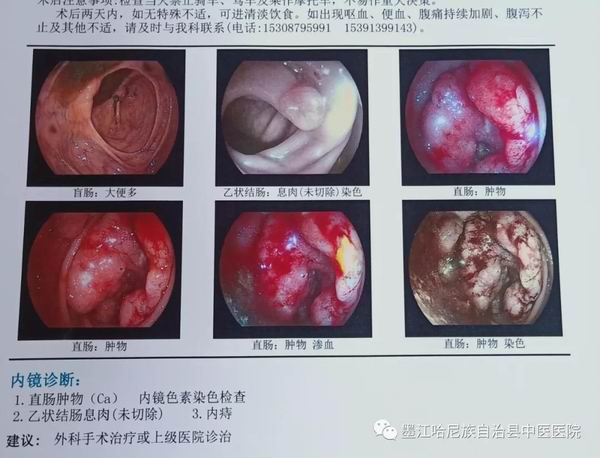 墨江县中医医院完成首例无辅助切口腹腔镜直肠癌根治术(图1)